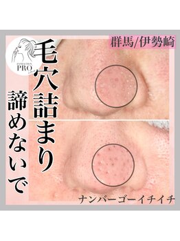 ナンバー511(No.511)/毛穴詰まり改善/メンズエステ