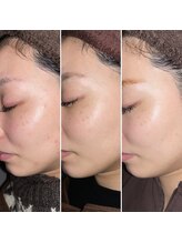 サス(SASU)/ハーブピーリングでツヤ肌を