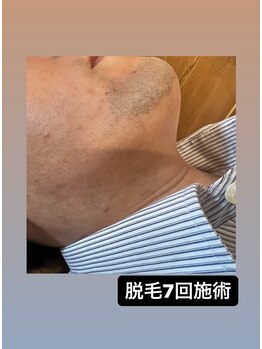 モアナ 前橋店(Moana)/髭脱毛7回