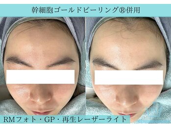 リメイククリニカルビューティー(Remake clinical beauty)/赤ら顔改善、トーンアップ