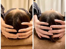 伊藤接骨院/小顔矯正1回でこの変化♪