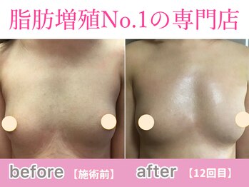 サラエクセレント 新宿(SARA EXCELLENT)/左右差改善でバストアップ！