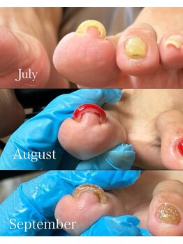 ネイルズ バイ ユイ 外苑前(Nails by Yui)/巻き爪ケアジェル