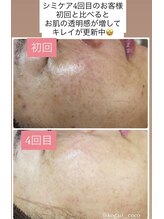 ココ(COCO)/シミケア、ビフォー、アフター