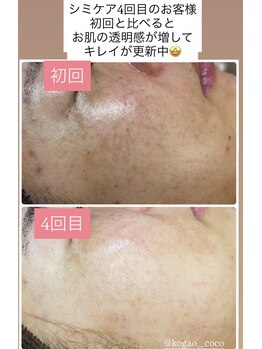ココ(COCO)/シミケア、ビフォー、アフター