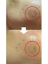 リセル(RE.cell)/シミケア5回後