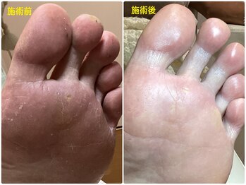 フットケアリストシュウ(footcarelist shu)/施術 フットケア《モテ男子♪》