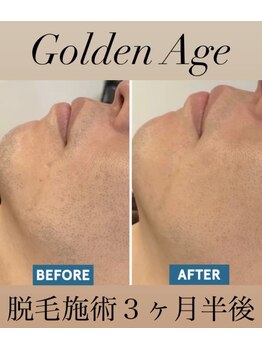ゴールデンエイジ(Golden Age)/【ヒゲ脱毛】Before&After