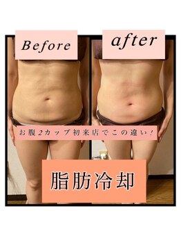 ティアメディカル(Tia Medical)/脂肪冷却