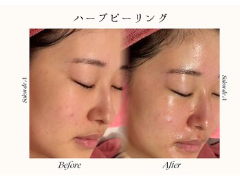 サロンドエー 帝塚山(Salon de A)/ハーブピーリング