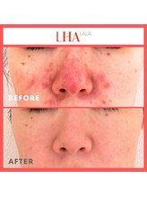 ルルドフォンテ(rurudo fonte.)/肌悩み改善にもララピール！