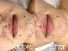 バーニー 梅田店(BARNEY)/ヒゲ脱毛　/脱毛/顔脱毛