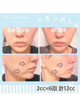 ハロ 南青山(HALO)/レモンボトルお顔