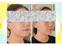 アン 銀座(ann)/二重あご/もたつき/小顔/むくみ