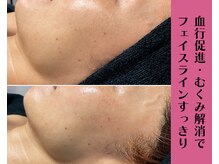 ヴィータ(VITA)/陶肌トリートメント