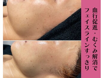 ヴィータ(VITA)/陶肌トリートメント