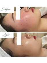 ビズビズ 梅田店(bisebise)/梅田ハーブピーリング/毛穴洗浄