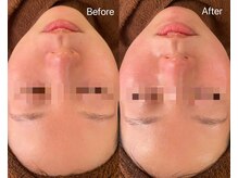 リアン(Lien)/毛穴洗浄ハイドロスプラッシュ