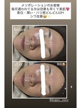 ココ(COCO)/メソポレーション