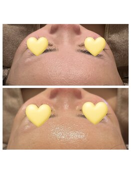 美温(mion)/おまかせフェイシャル