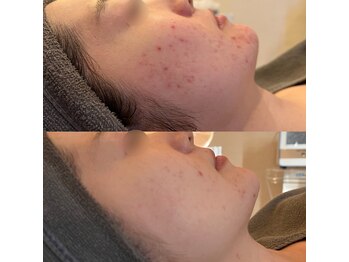 ラドンナ(LA DONNA)/ニキビ改善