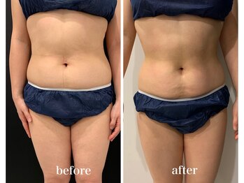 スパチャーレ(Spa ciare)/フォースカッター 90分8回