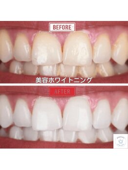 グロウ 東区香椎(GLOW)/美容ホワイトニング