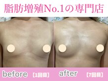 サラエクセレント 新宿(SARA EXCELLENT)/やせ型でもふっくらバストアップ