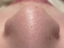 リセットプラス(Reset+)/お鼻の産毛目立っていませんか？