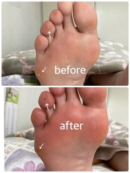 フロー(Froh)/深いウオノメ