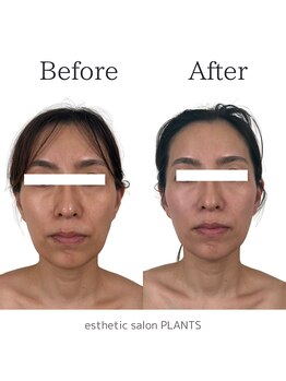 プランツ(PLANTS)/40代／１回／たるみ・小顔
