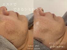 シェア(share.)の雰囲気(エステでもシミケアができる◎アンストレス/イラストリアス/毛穴)