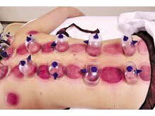 中医美容健康サロン 妙蓮/カッピング背中