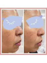 ローズ バイ フェリーチェ(Rose by felice)/リフトアップ☆あご、ほほ