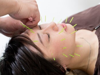 溝口鍼灸整骨院/顔鍼施術