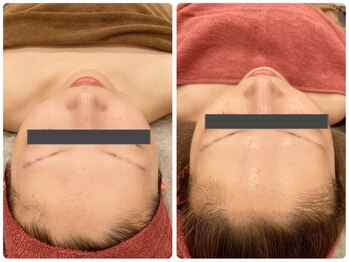 マリスレジーナ 新保店(MarisRegina)/ララピール 1回 BeforeAfter