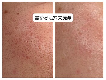 アロマ(AROMA)/凹凸ケア、赤ニキビケア　(3)