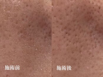 キーオブフェイス(Key of Face)/お悩み【毛穴詰まり】