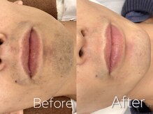 バーニー 梅田店(BARNEY)/ヒゲ脱毛　/脱毛/顔脱毛