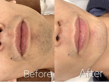 バーニー 梅田店(BARNEY)/ヒゲ脱毛　/脱毛/顔脱毛