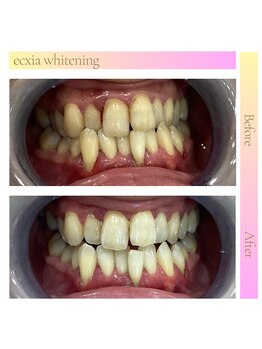 エクシアホワイトニング 和歌山本町店/ホワイトニングビフォーアフター