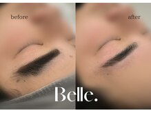 ベル(Belle)/【症例】美眉