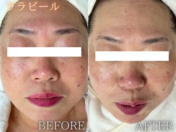 レイネ(REINE)/韓国肌管理★ララピール