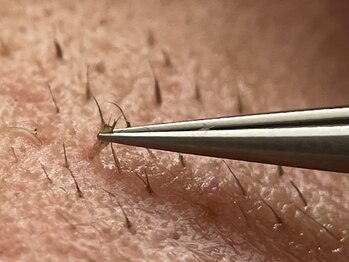 レーヌ(REINE)の写真/そんなに細かいところまで...！《感激のお顔脱毛に出会えます★》顔脱毛・眉脱毛・鼻周りの黒ずみケアに◎