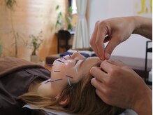 こと鍼灸院・整骨院/頭皮鍼