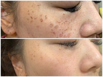 ノート(NOTE)/しみケア20分＋美容液導入