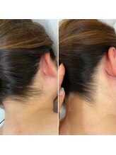 インベスト(INVEST)/うなじ脱毛