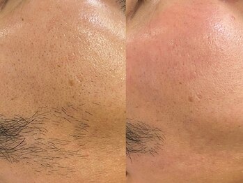 モルフォム(Morphome)/【メンズ】フェイスワックス