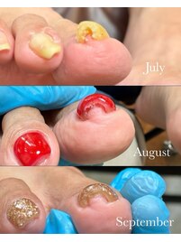 巻き爪ケアジェル