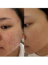 パルティール 渋谷店 partir/大人気！パスリルの効果！